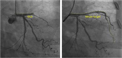 Novel Analysis of Coronary Angiography in Predicting the Formation of Ventricular Aneurysm in Patients With Acute Myocardial Infarction After Percutaneous Coronary Intervention